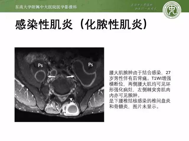 【PPT】软组织感染的影像学表现：从蜂窝织炎到坏死性筋膜炎