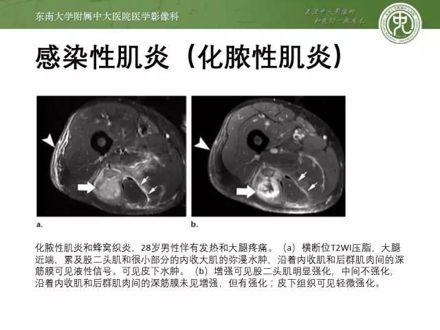 【PPT】软组织感染的影像学表现：从蜂窝织炎到坏死性筋膜炎