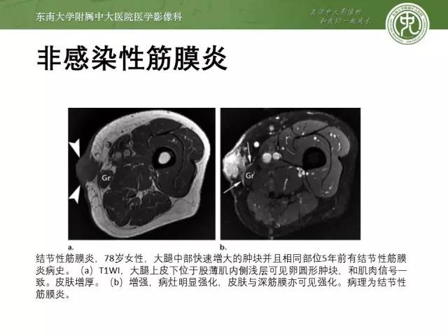 【PPT】软组织感染的影像学表现：从蜂窝织炎到坏死性筋膜炎