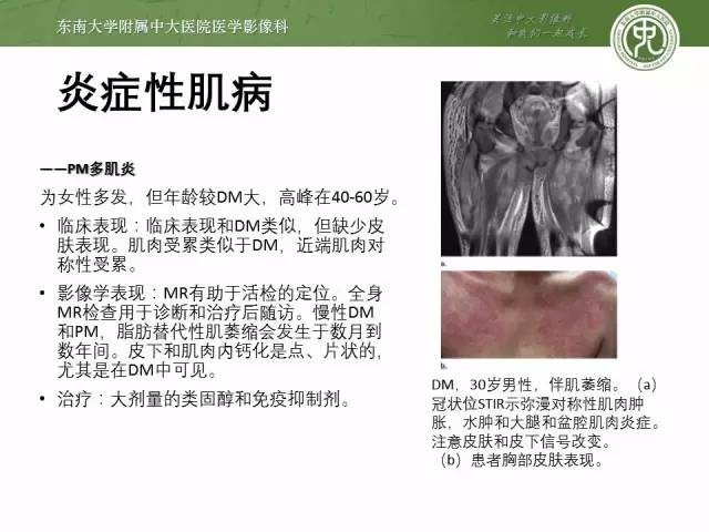 【PPT】软组织感染的影像学表现：从蜂窝织炎到坏死性筋膜炎
