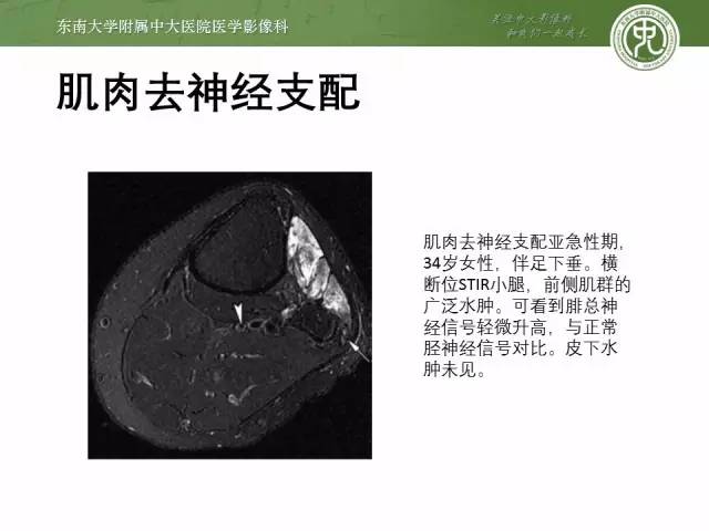 【PPT】软组织感染的影像学表现：从蜂窝织炎到坏死性筋膜炎
