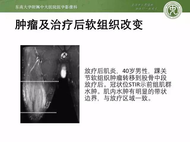 【PPT】软组织感染的影像学表现：从蜂窝织炎到坏死性筋膜炎