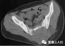 【病例】骶骨动脉瘤样骨囊肿1例CT影像表现 【病例】骶骨动脉瘤样骨囊肿1例CT影像表现
