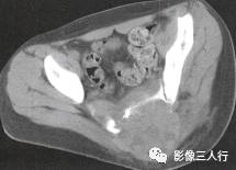 【病例】骶骨动脉瘤样骨囊肿1例CT影像表现