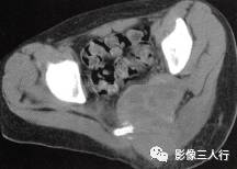 【病例】骶骨动脉瘤样骨囊肿1例CT影像表现 【病例】骶骨动脉瘤样骨囊肿1例CT影像表现