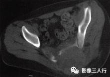 【病例】骶骨动脉瘤样骨囊肿1例CT影像表现 【病例】骶骨动脉瘤样骨囊肿1例CT影像表现