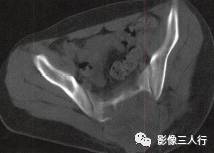 【病例】骶骨动脉瘤样骨囊肿1例CT影像表现 【病例】骶骨动脉瘤样骨囊肿1例CT影像表现