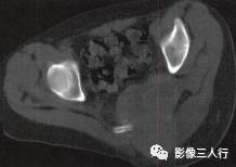 【病例】骶骨动脉瘤样骨囊肿1例CT影像表现 【病例】骶骨动脉瘤样骨囊肿1例CT影像表现