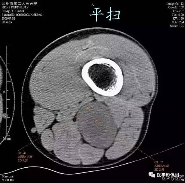 【病例】大腿肌间神经鞘瘤1例CT影像表现