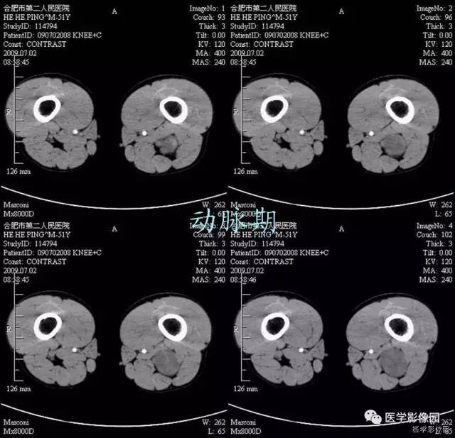 【病例】大腿肌间神经鞘瘤1例CT影像表现