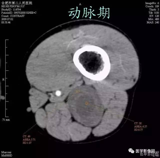 【病例】大腿肌间神经鞘瘤1例CT影像表现