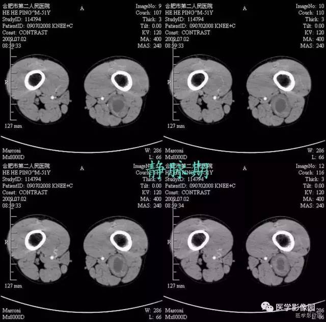 【病例】大腿肌间神经鞘瘤1例CT影像表现