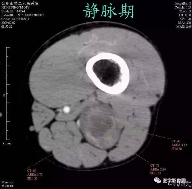 【病例】大腿肌间神经鞘瘤1例CT影像表现