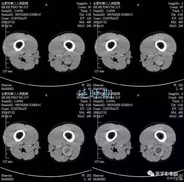 【病例】大腿肌间神经鞘瘤1例CT影像表现