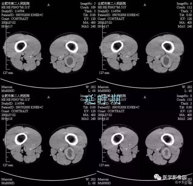 【病例】大腿肌间神经鞘瘤1例CT影像表现