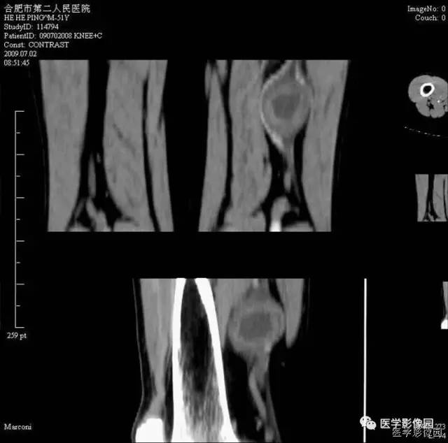 【病例】大腿肌间神经鞘瘤1例CT影像表现