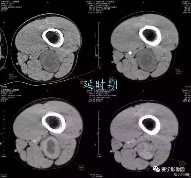 【病例】大腿肌间神经鞘瘤1例CT影像表现