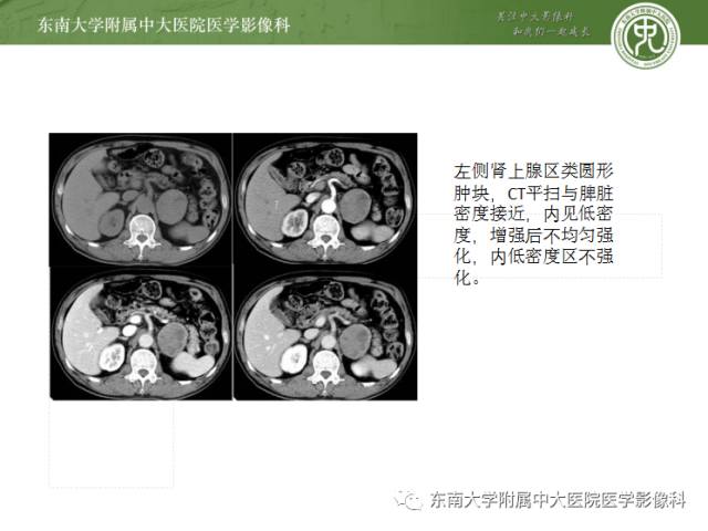 【病例】肾上腺嗜铬细胞瘤1例CT影像表现与鉴别 【病例】肾上腺嗜铬细胞瘤1例CT影像表现与鉴别