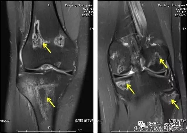 【病例】多发骨缺血坏死1例CT及MR