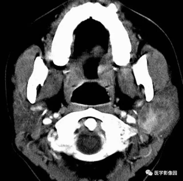 涎腺多形性腺瘤—混合瘤 涎腺多形性腺瘤—混合瘤