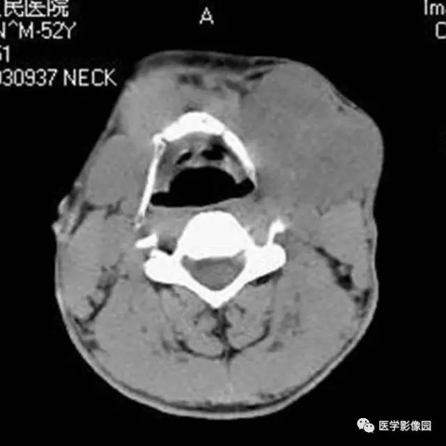涎腺多形性腺瘤—混合瘤 涎腺多形性腺瘤—混合瘤