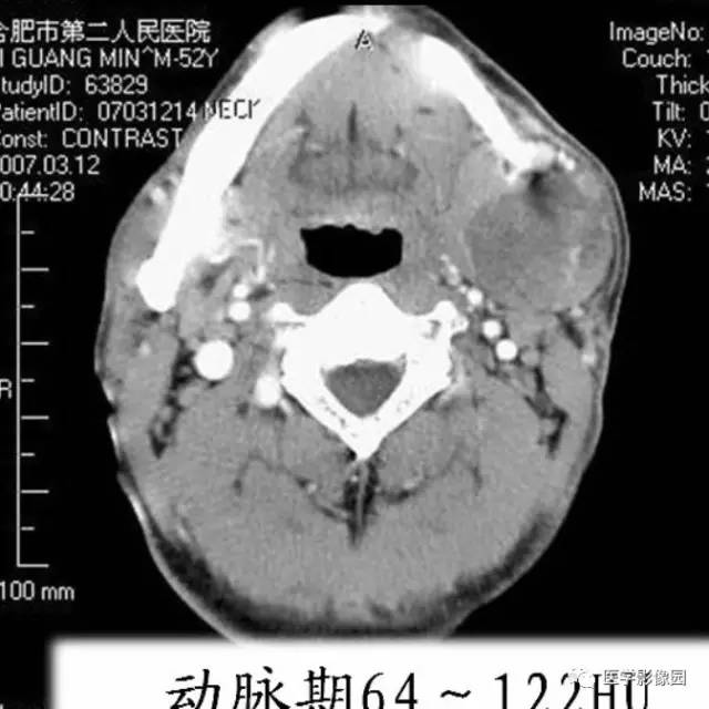涎腺多形性腺瘤—混合瘤 涎腺多形性腺瘤—混合瘤