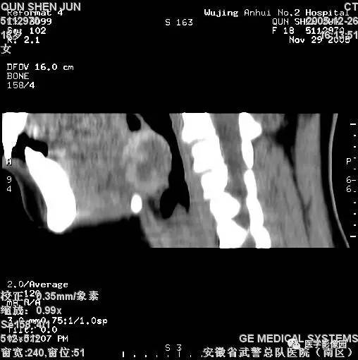 涎腺多形性腺瘤—混合瘤 涎腺多形性腺瘤—混合瘤