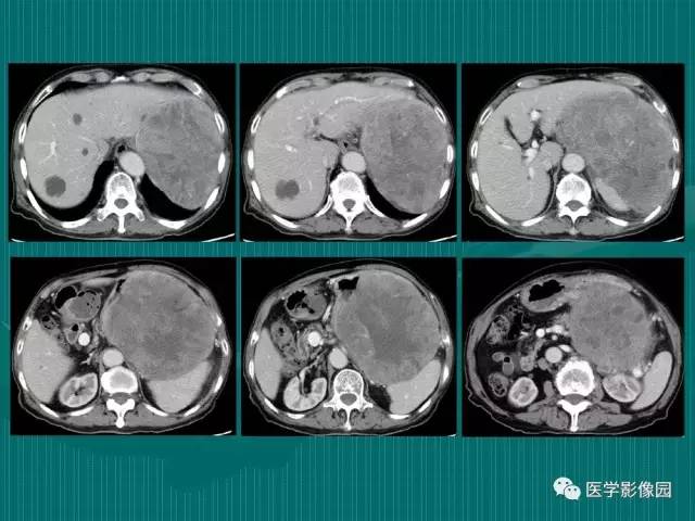 【病例】不典型肝癌2例CT及MR影像表现