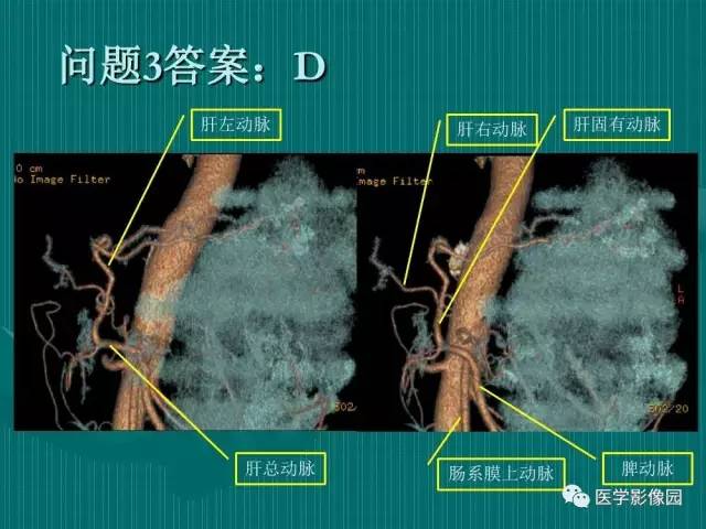 【病例】不典型肝癌2例CT及MR影像表现