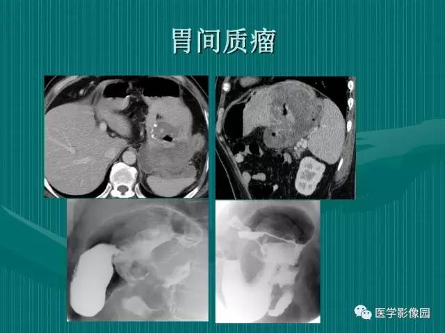 【病例】不典型肝癌2例CT及MR影像表现