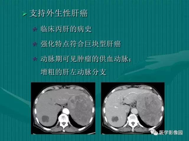 【病例】不典型肝癌2例CT及MR影像表现