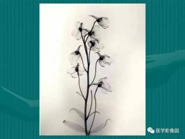【病例】不典型肝癌2例CT及MR影像表现