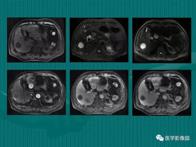 【病例】不典型肝癌2例CT及MR影像表现