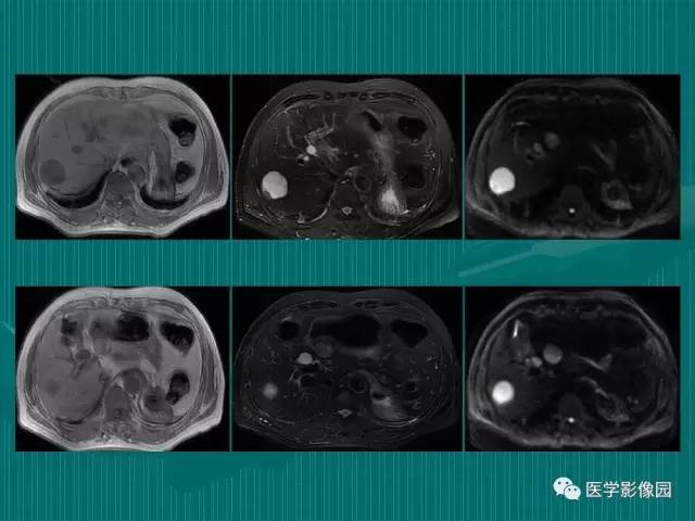 【病例】不典型肝癌2例CT及MR影像表现