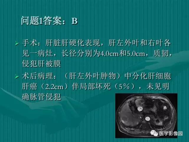 【病例】不典型肝癌2例CT及MR影像表现