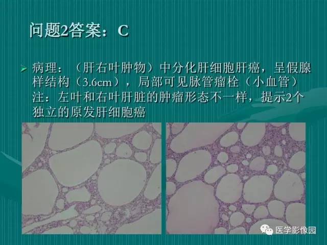 【病例】不典型肝癌2例CT及MR影像表现