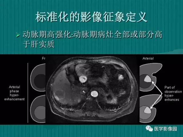 【病例】不典型肝癌2例CT及MR影像表现