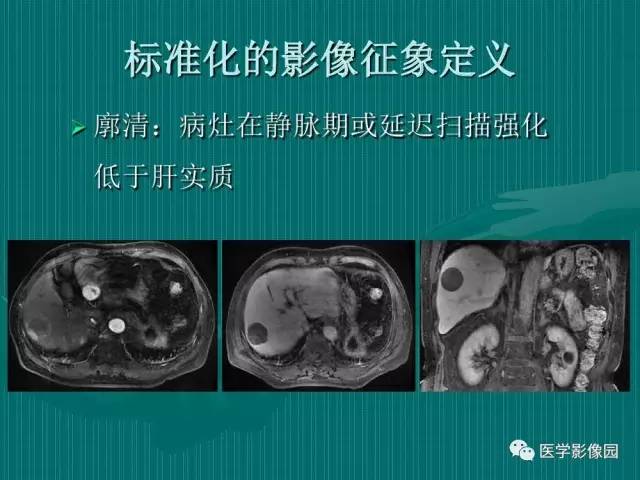 【病例】不典型肝癌2例CT及MR影像表现