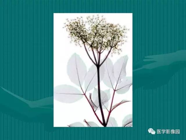 【病例】不典型肝癌2例CT及MR影像表现