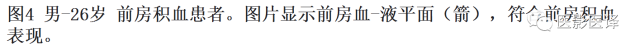 眼球外伤:影像医生阅片必须注意的地方 眼球外伤:影像医生阅片必须注意的地方