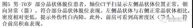 眼球外伤:影像医生阅片必须注意的地方 眼球外伤:影像医生阅片必须注意的地方