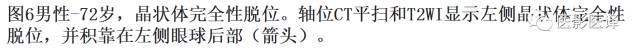 眼球外伤:影像医生阅片必须注意的地方 眼球外伤:影像医生阅片必须注意的地方