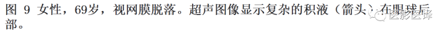 眼球外伤:影像医生阅片必须注意的地方 眼球外伤:影像医生阅片必须注意的地方