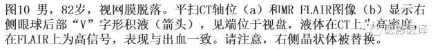 眼球外伤:影像医生阅片必须注意的地方 眼球外伤:影像医生阅片必须注意的地方