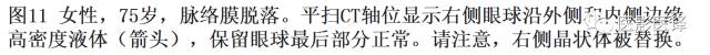 眼球外伤:影像医生阅片必须注意的地方 眼球外伤:影像医生阅片必须注意的地方