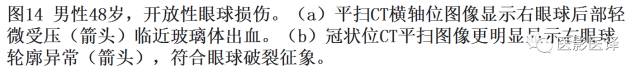 眼球外伤:影像医生阅片必须注意的地方 眼球外伤:影像医生阅片必须注意的地方
