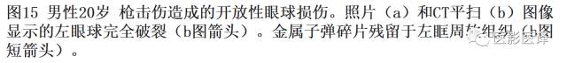 眼球外伤:影像医生阅片必须注意的地方 眼球外伤:影像医生阅片必须注意的地方