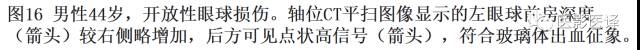 眼球外伤:影像医生阅片必须注意的地方 眼球外伤:影像医生阅片必须注意的地方