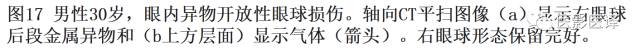 眼球外伤:影像医生阅片必须注意的地方 眼球外伤:影像医生阅片必须注意的地方
