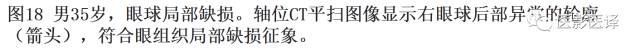 眼球外伤:影像医生阅片必须注意的地方 眼球外伤:影像医生阅片必须注意的地方